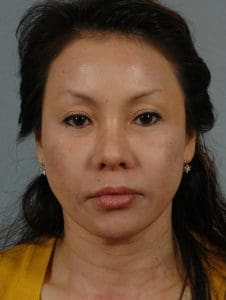 Lip Lift - Case 16323 - Before