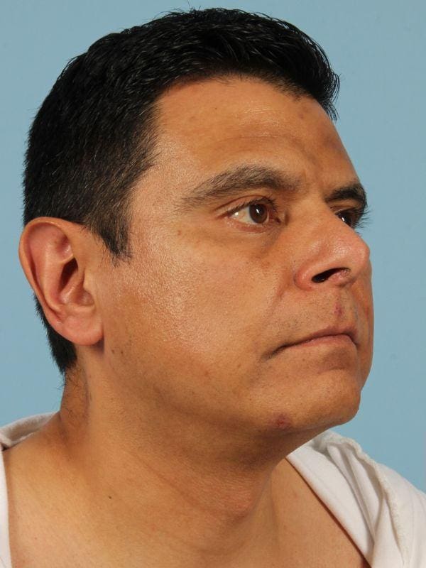 Lip Lift Patient Photo - Case 16328 - before view-1