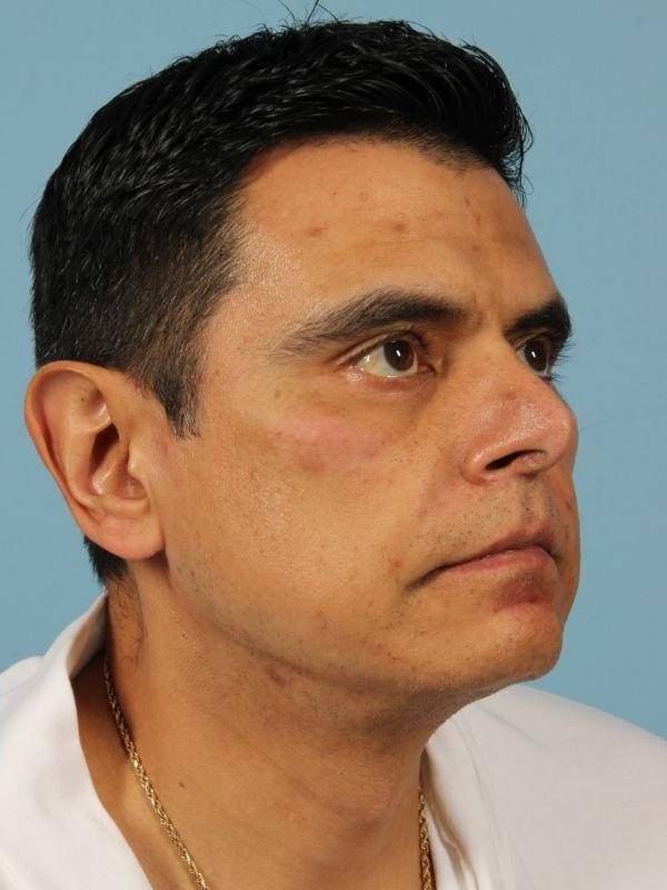 Lip Lift Patient Photo - Case 16328 - after view-1