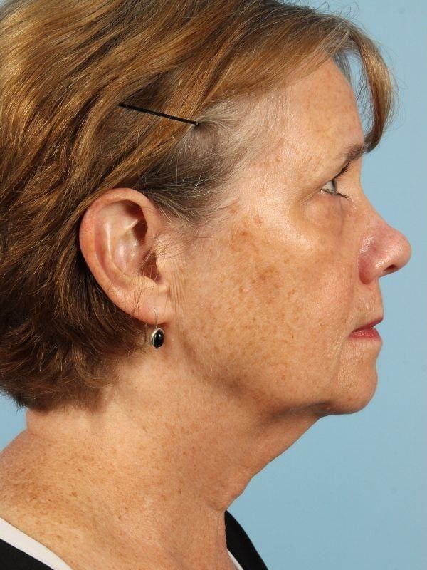 Obagi Patient Photo - Case 16341 - before view-2