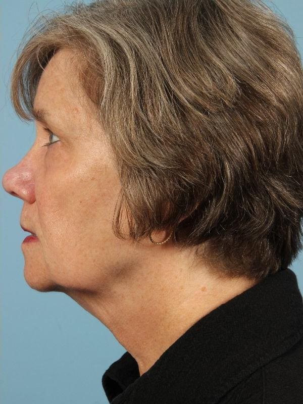 Obagi Patient Photo - Case 16341 - after view-1