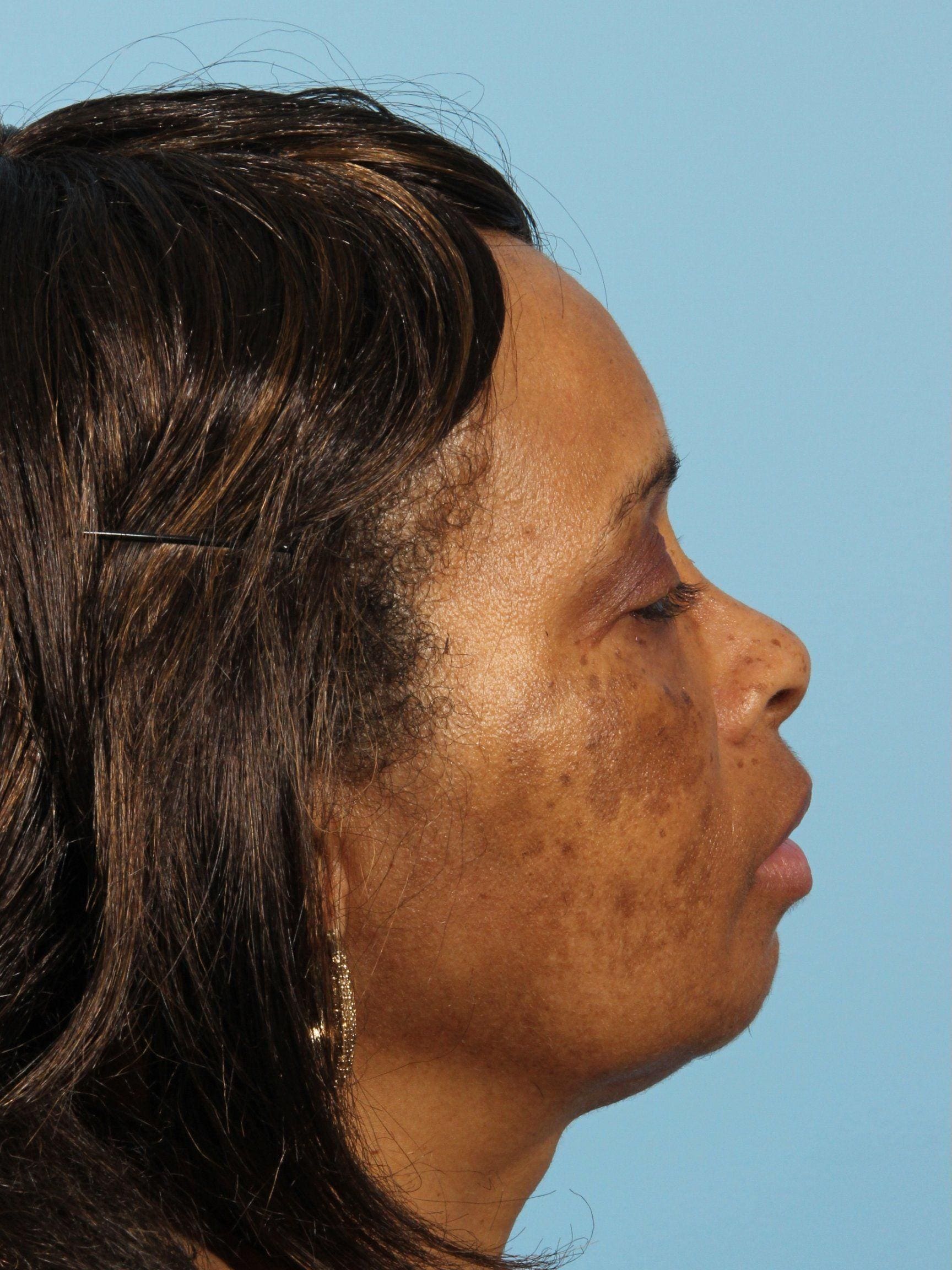 Obagi Patient Photo - Case 16354 - before view-2