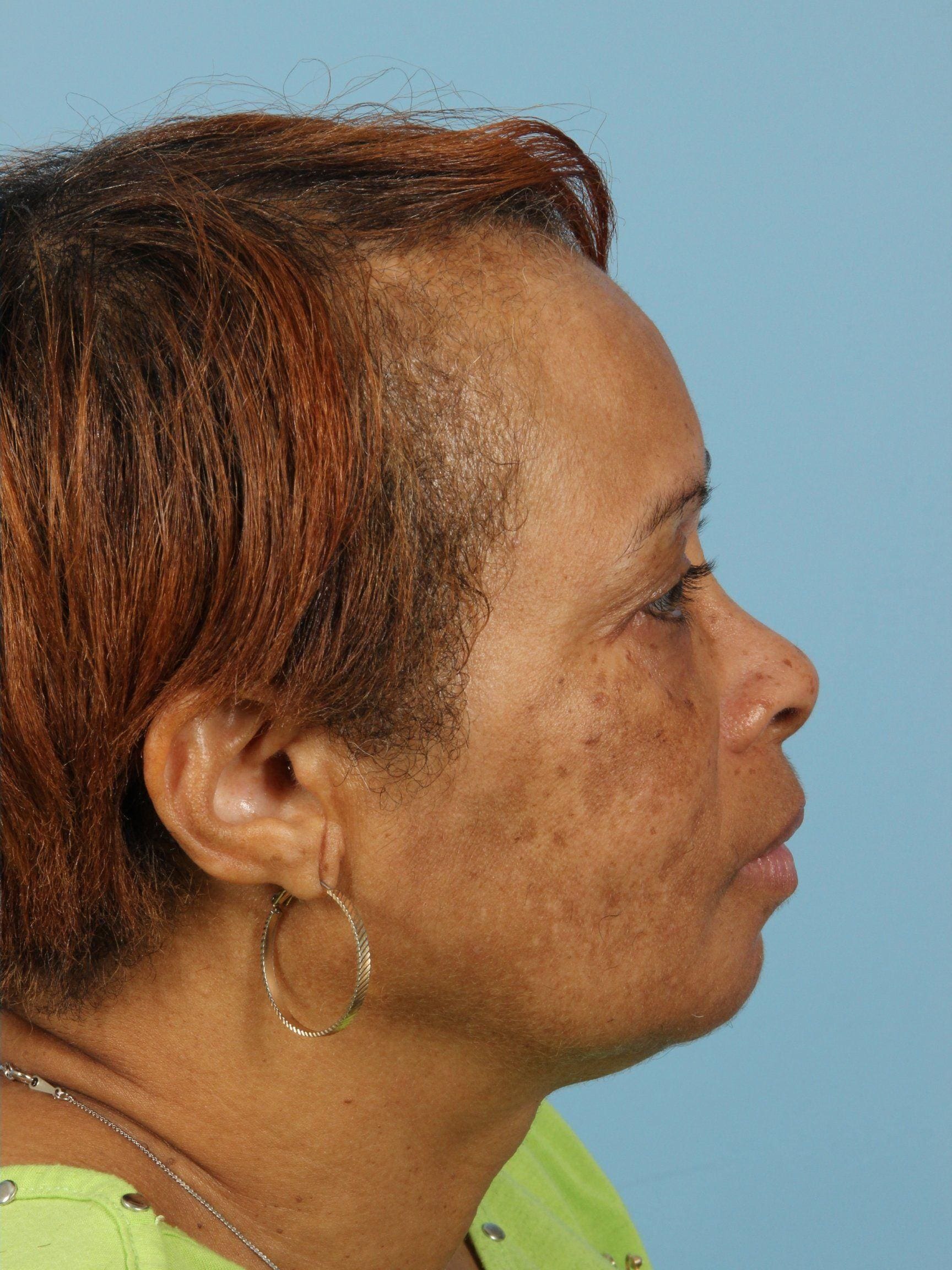 Obagi Patient Photo - Case 16354 - after view-2