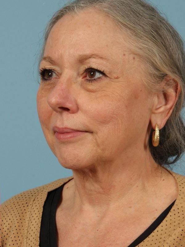 Obagi Patient Photo - Case 16366 - after view-3