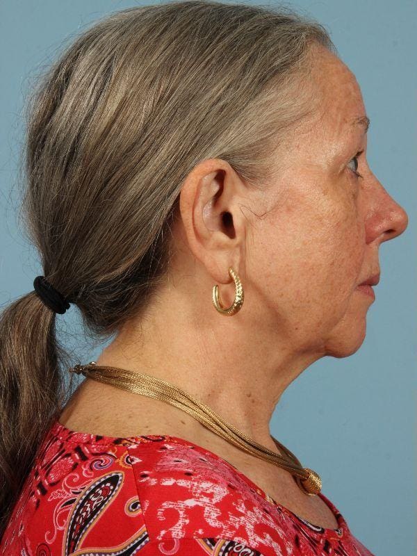 Obagi Patient Photo - Case 16366 - before view-2