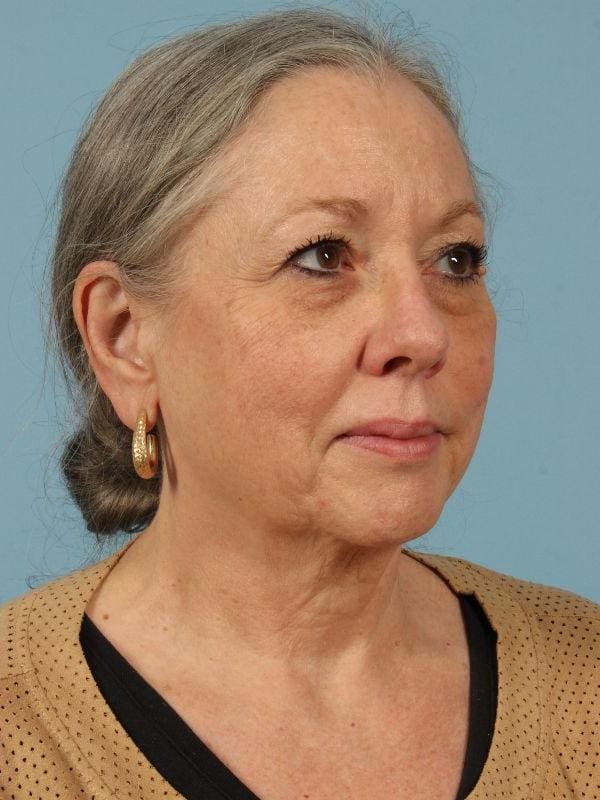 Obagi Patient Photo - Case 16366 - after view-4