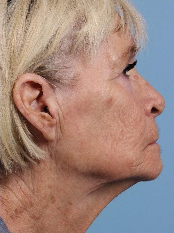 Obagi Patient Photo - Case 16378 - after view-2