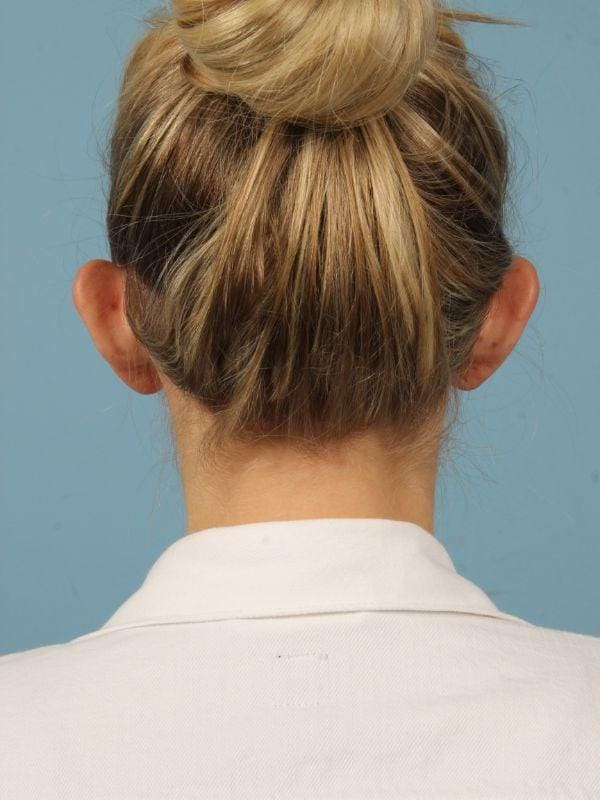 Otoplasty Patient Photo - Case 16413 - before view-1