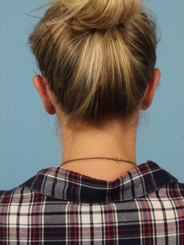 Otoplasty Patient Photo - Case 16413 - after view-1
