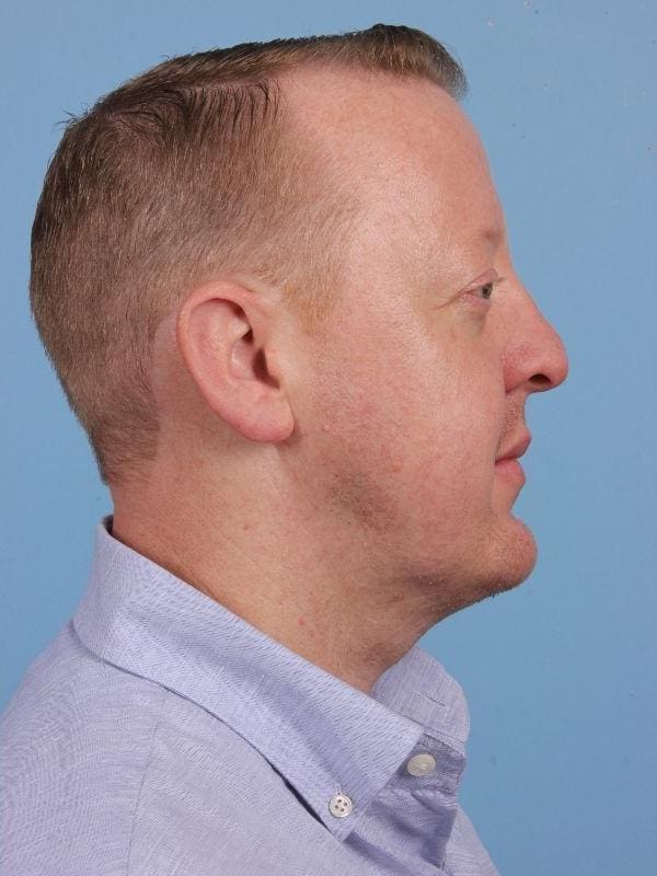 Renuvion Patient Photo - Case 16420 - after view-2