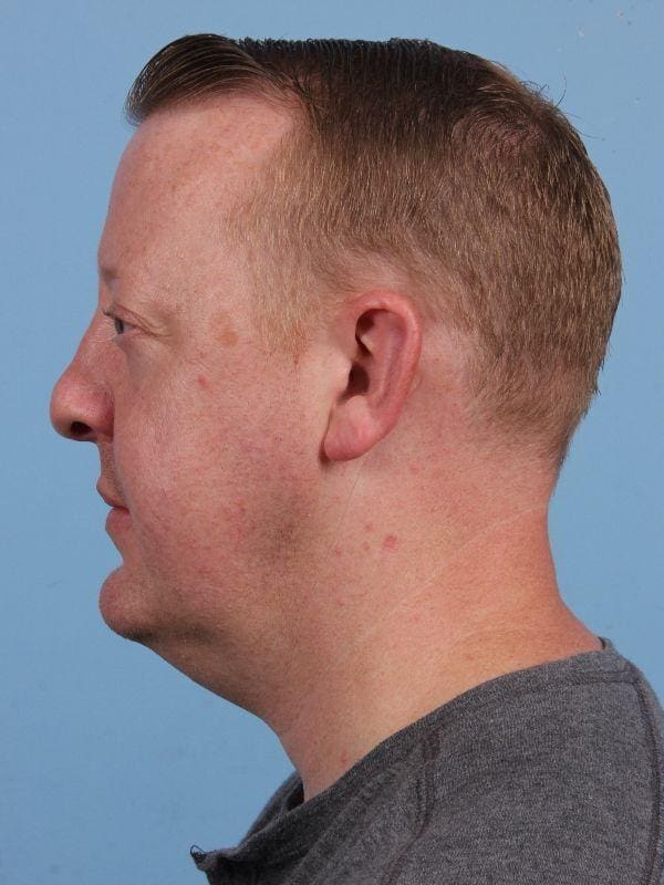 Renuvion Patient Photo - Case 16420 - before view-1