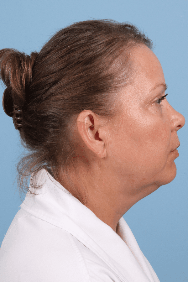 Renuvion Patient Photo - Case 16432 - before view-2