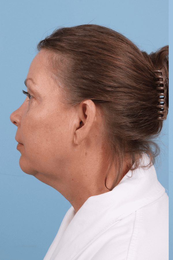 Renuvion Patient Photo - Case 16432 - before view-1