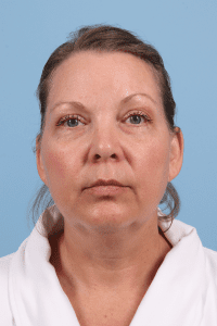 Renuvion - Case 16432 - Before