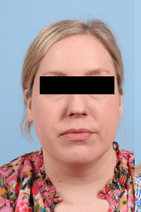 Renuvion - Case 16445 - Before