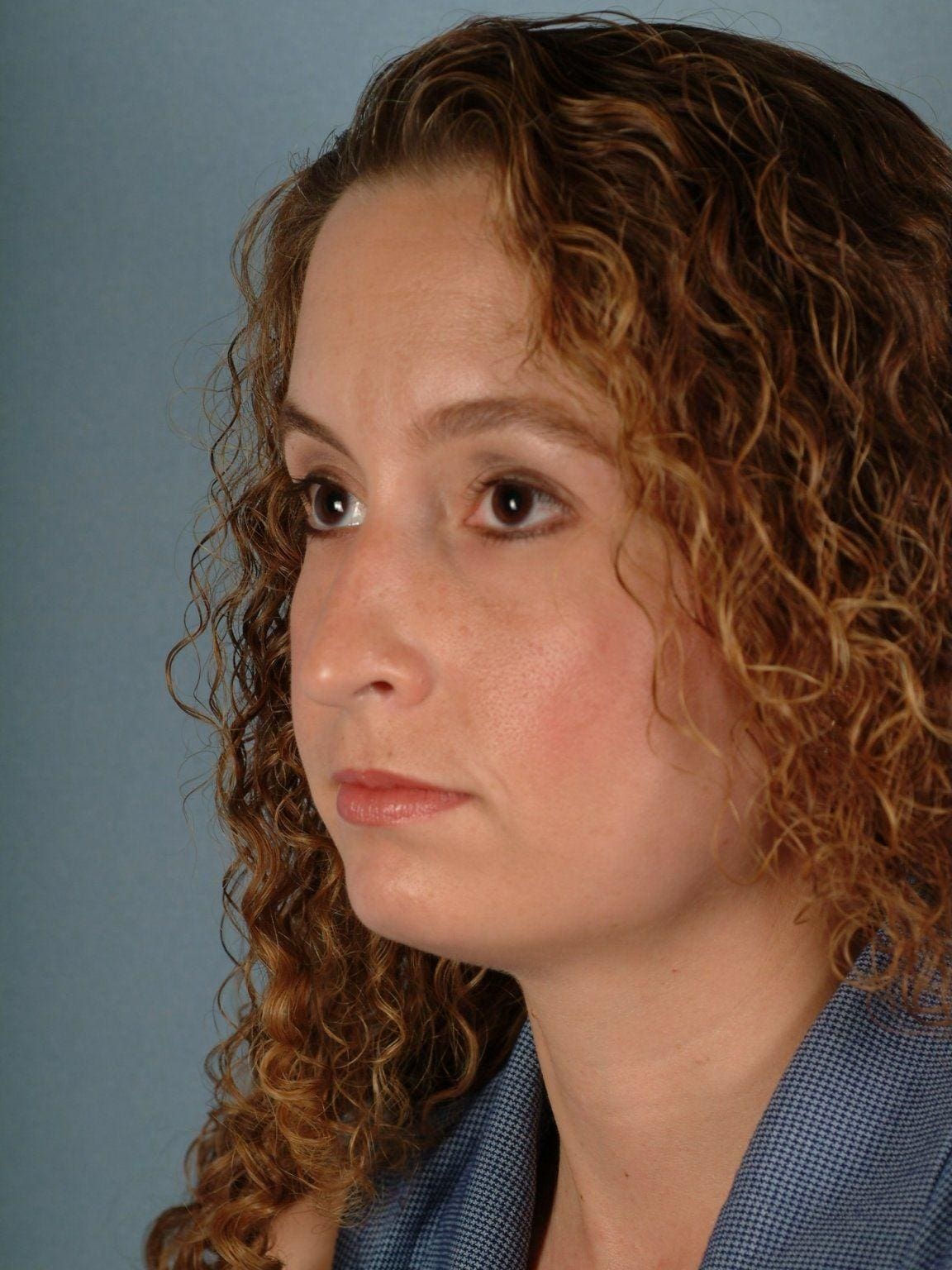 Rhinoplasty Patient Photo - Case 16457 - before view-3