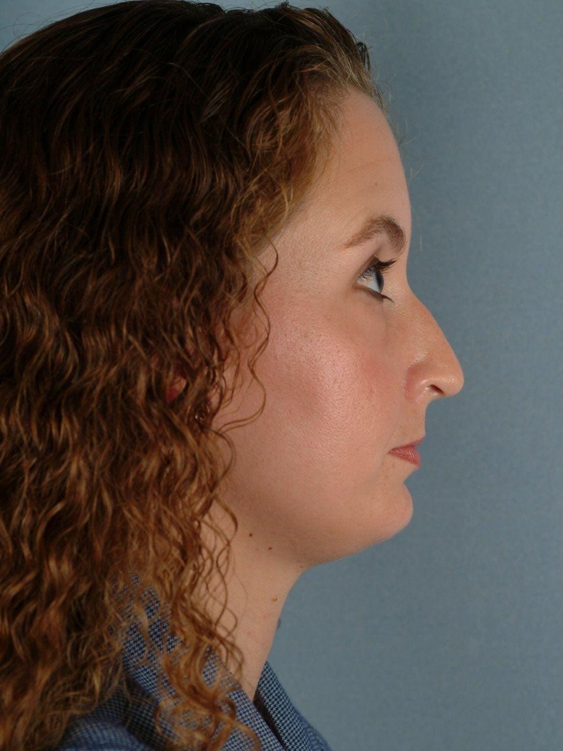 Rhinoplasty Patient Photo - Case 16457 - before view-2