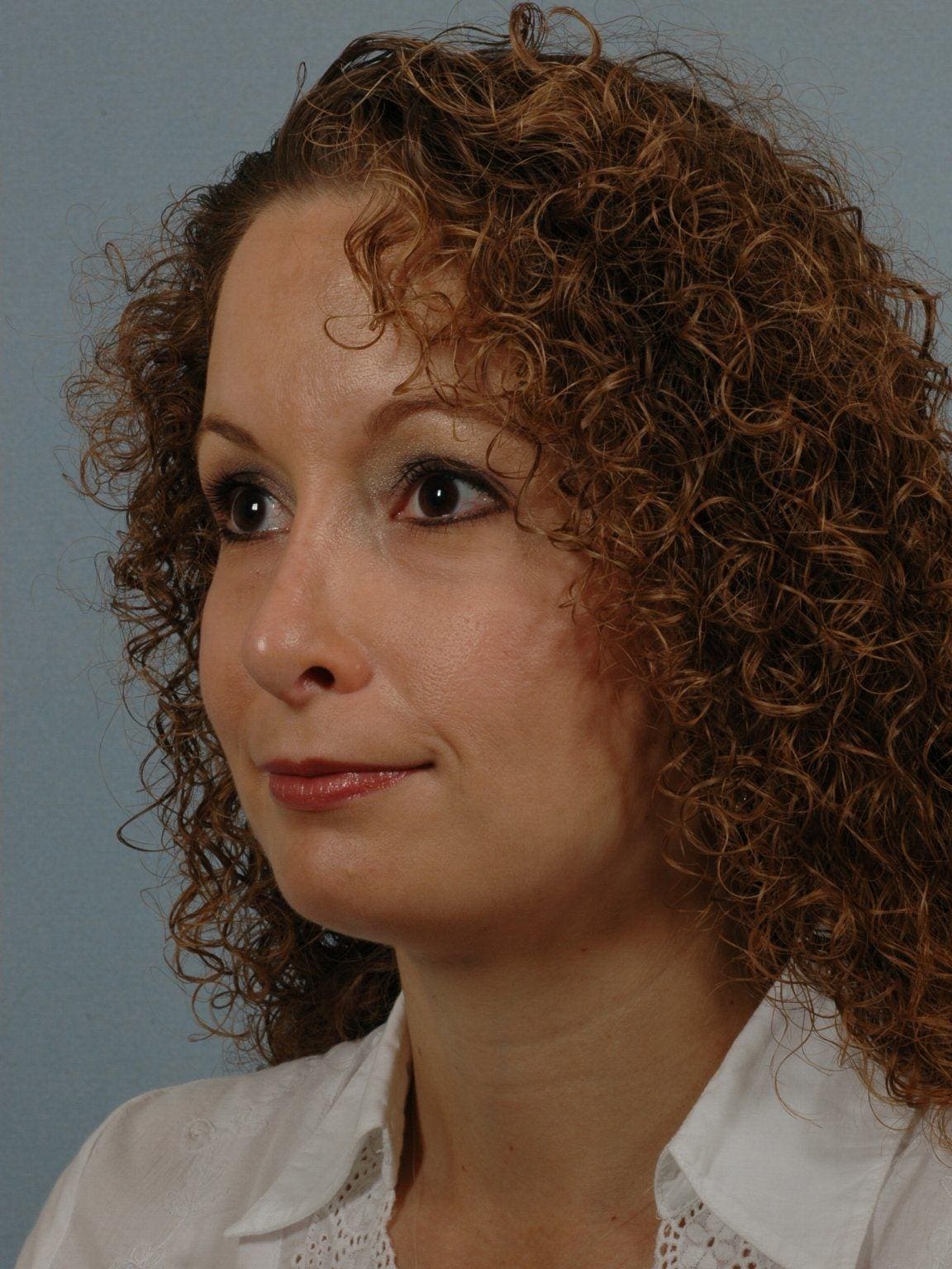 Rhinoplasty Patient Photo - Case 16457 - after view-3