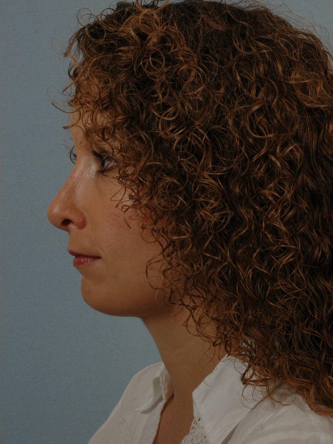 Rhinoplasty Patient Photo - Case 16457 - after view-1