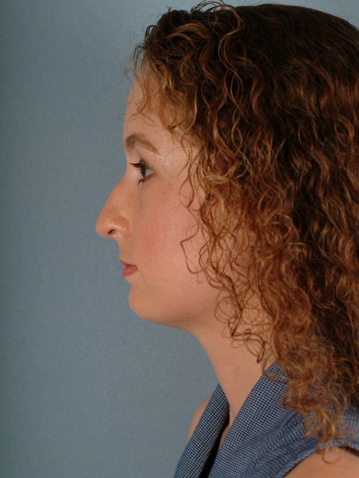 Rhinoplasty Patient Photo - Case 16457 - before view-1
