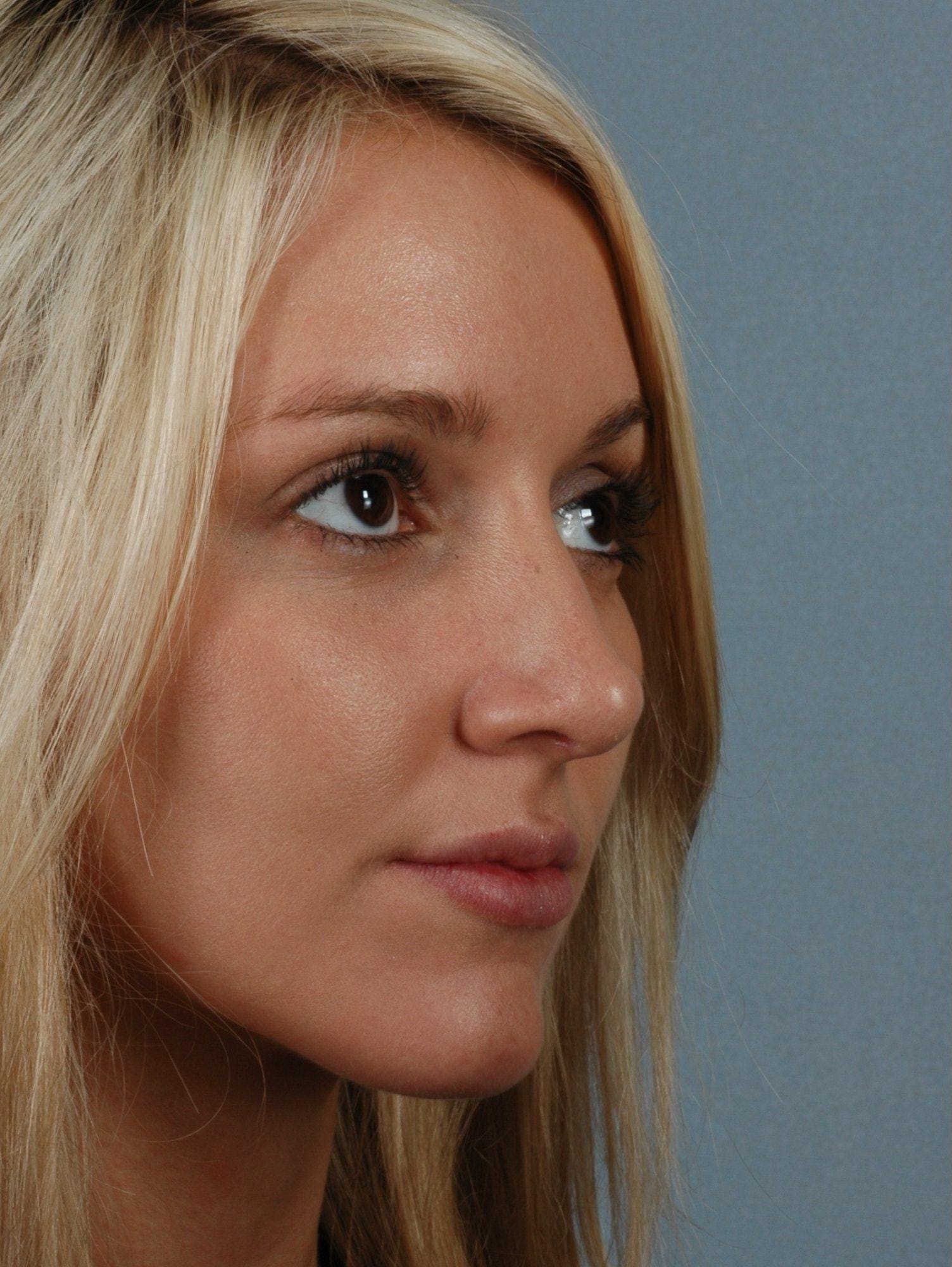 Rhinoplasty Patient Photo - Case 16467 - before view-4