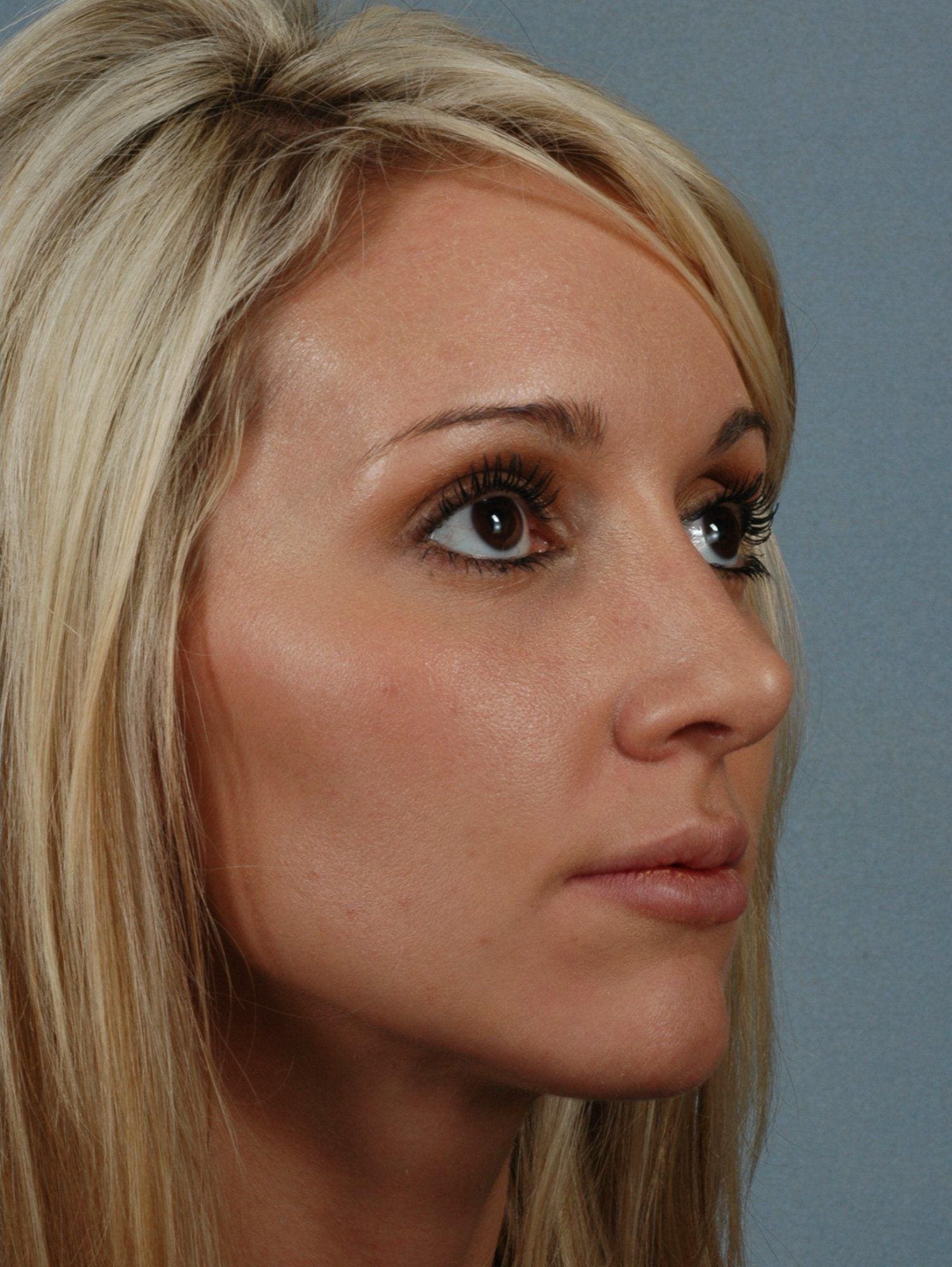 Rhinoplasty Patient Photo - Case 16467 - after view-4