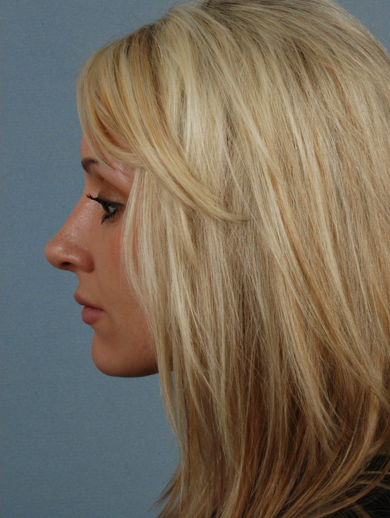 Rhinoplasty Patient Photo - Case 16467 - after view-1