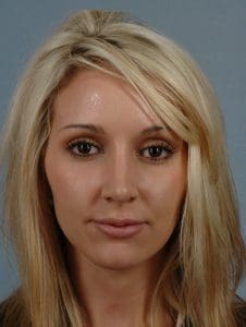 Rhinoplasty - Case 16467 - After