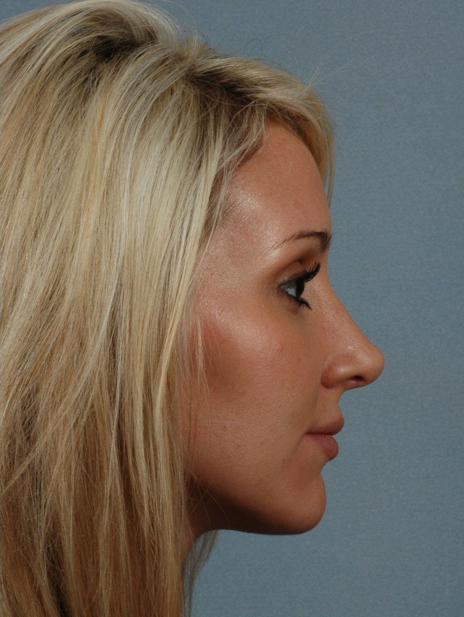 Rhinoplasty Patient Photo - Case 16467 - after view-2