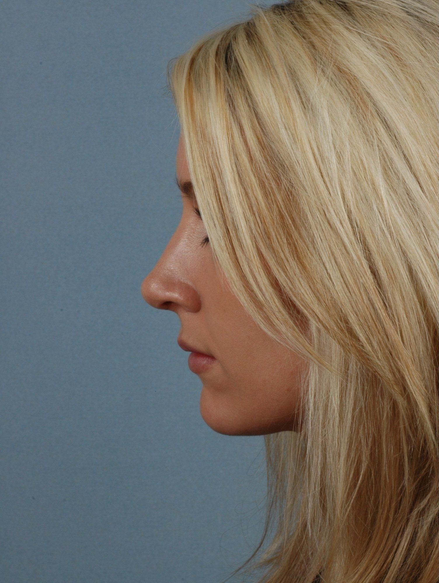 Rhinoplasty Patient Photo - Case 16467 - before view-1