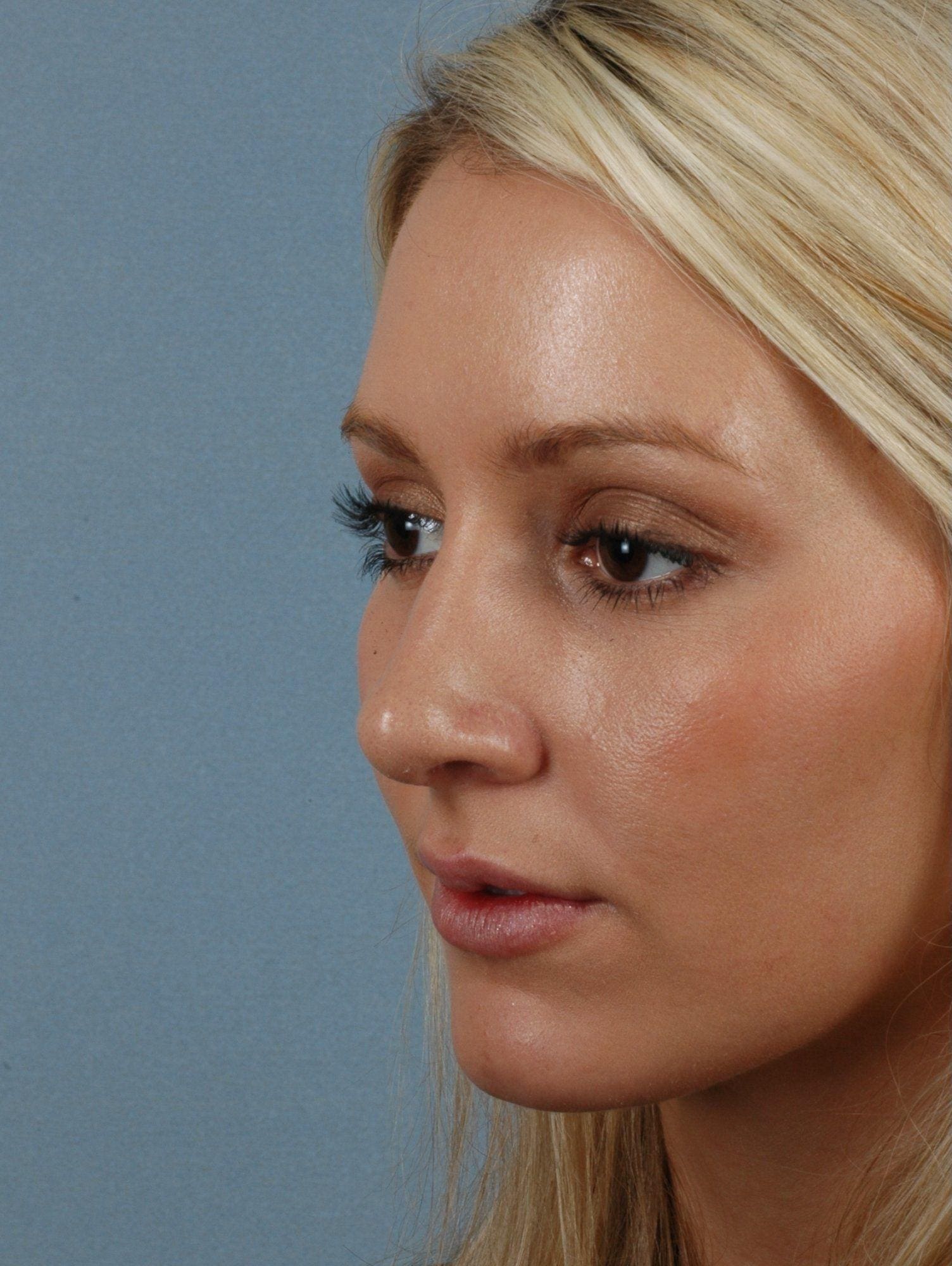 Rhinoplasty Patient Photo - Case 16467 - before view-3