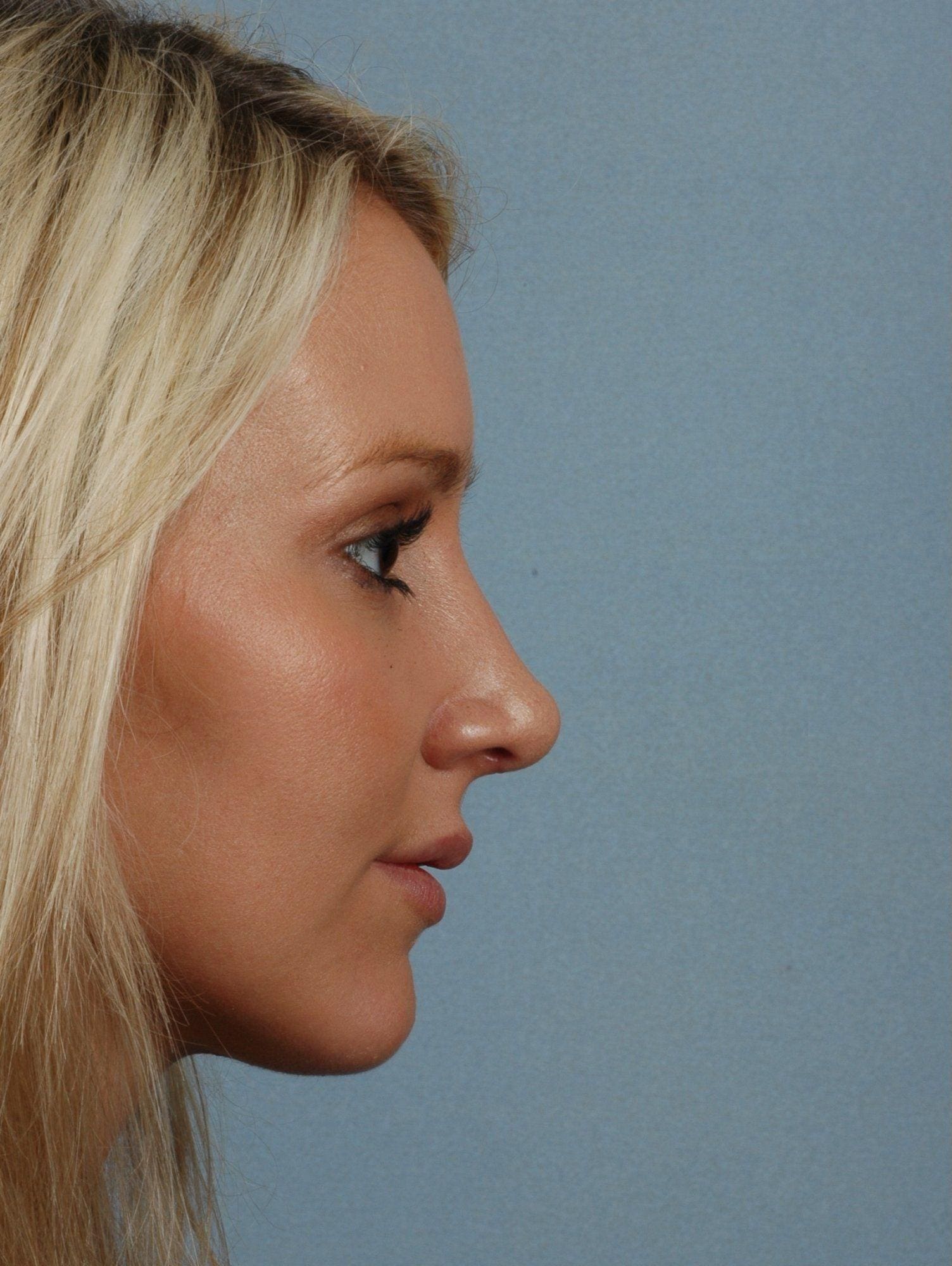 Rhinoplasty Patient Photo - Case 16467 - before view-2