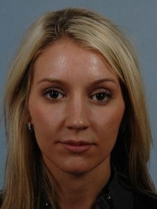 Rhinoplasty - Case 16467 - Before
