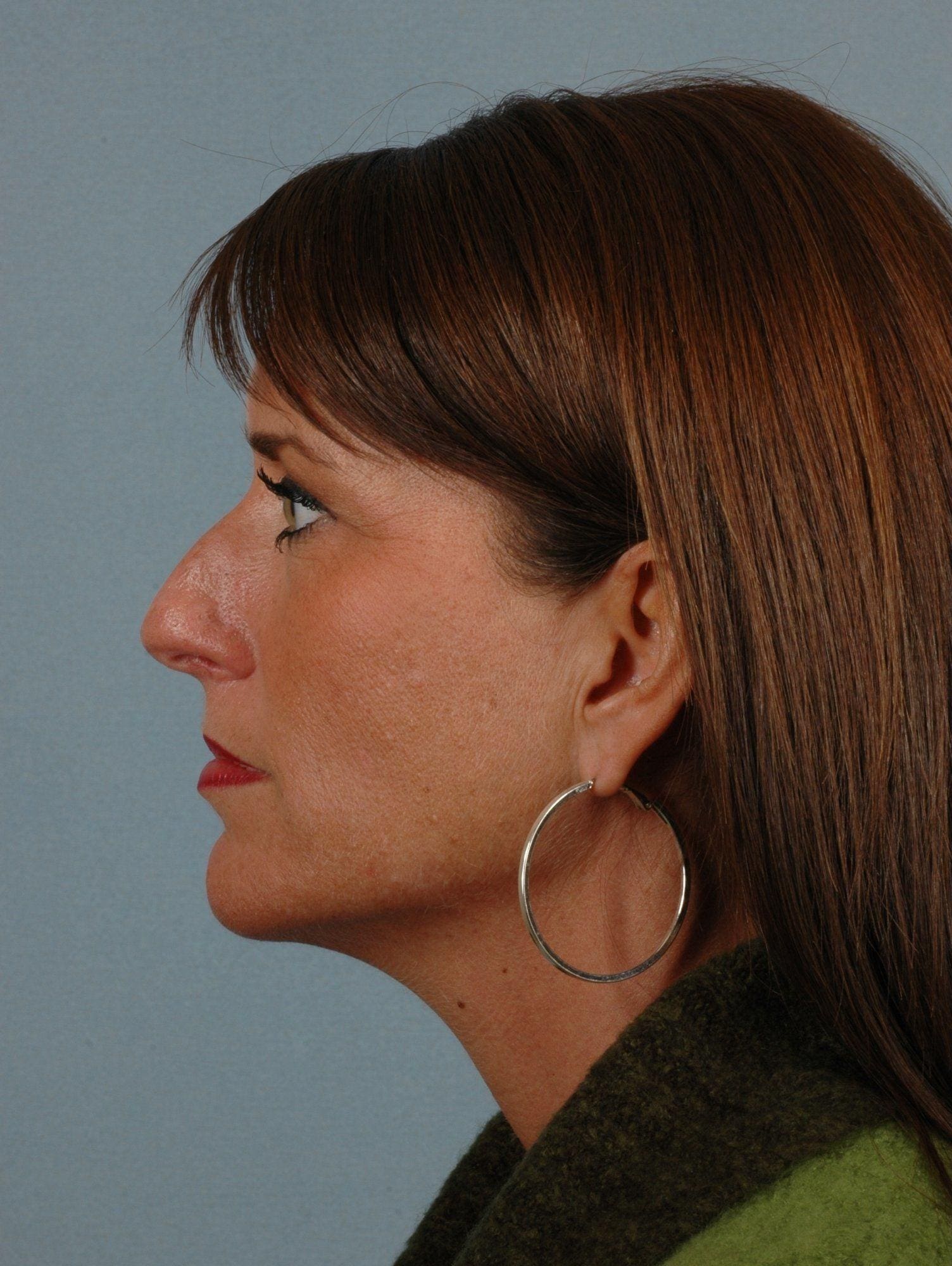 Rhinoplasty Patient Photo - Case 16480 - before view-1