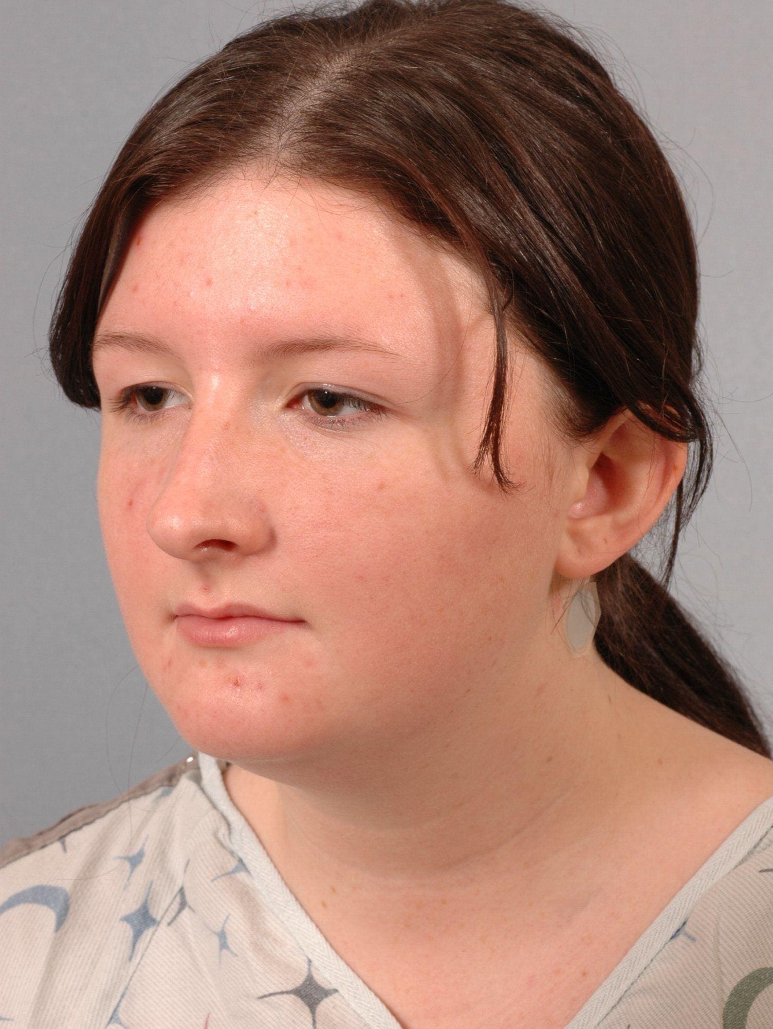 Rhinoplasty Patient Photo - Case 16486 - before view-1
