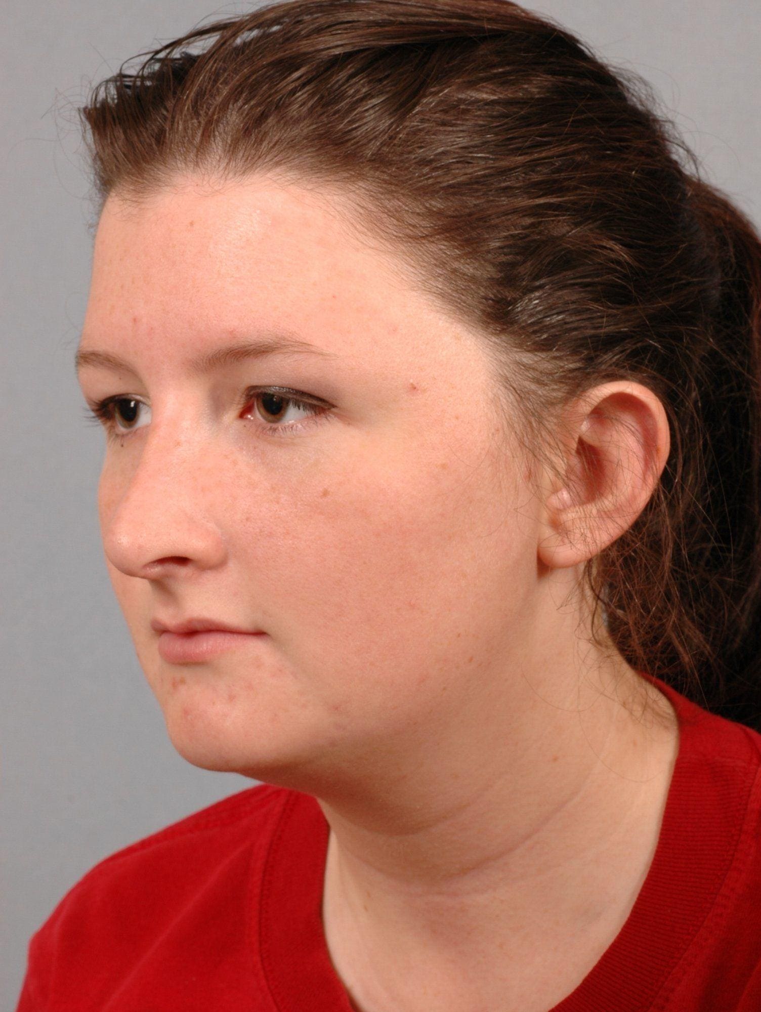 Rhinoplasty Patient Photo - Case 16486 - after view-1