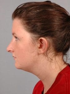 Rhinoplasty - Case 16486 - After