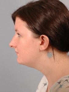 Rhinoplasty - Case 16486 - Before