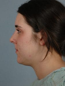 Rhinoplasty - Case 16492 - Before