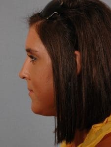 Rhinoplasty - Case 16492 - After