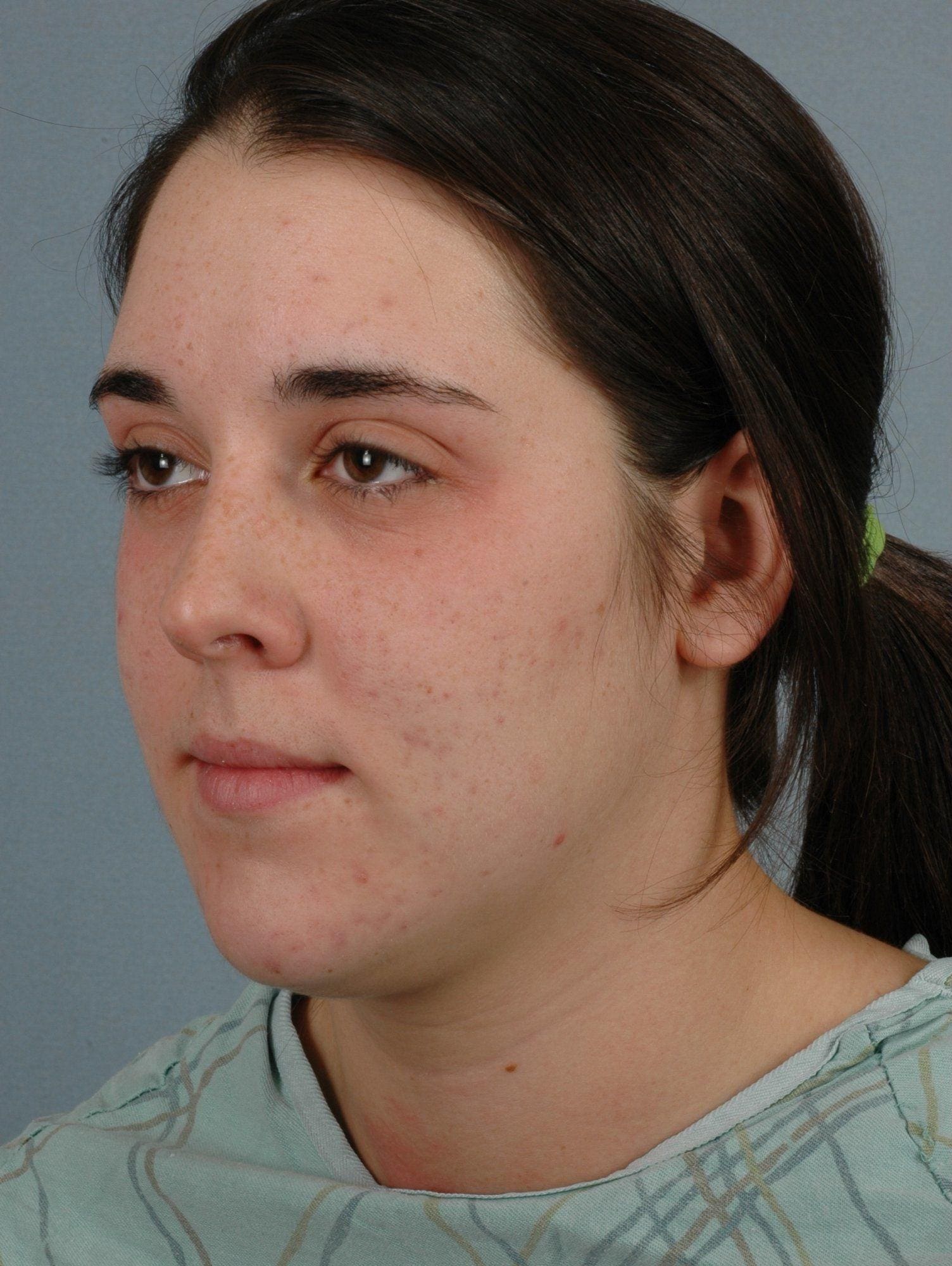 Rhinoplasty Patient Photo - Case 16492 - before view-1
