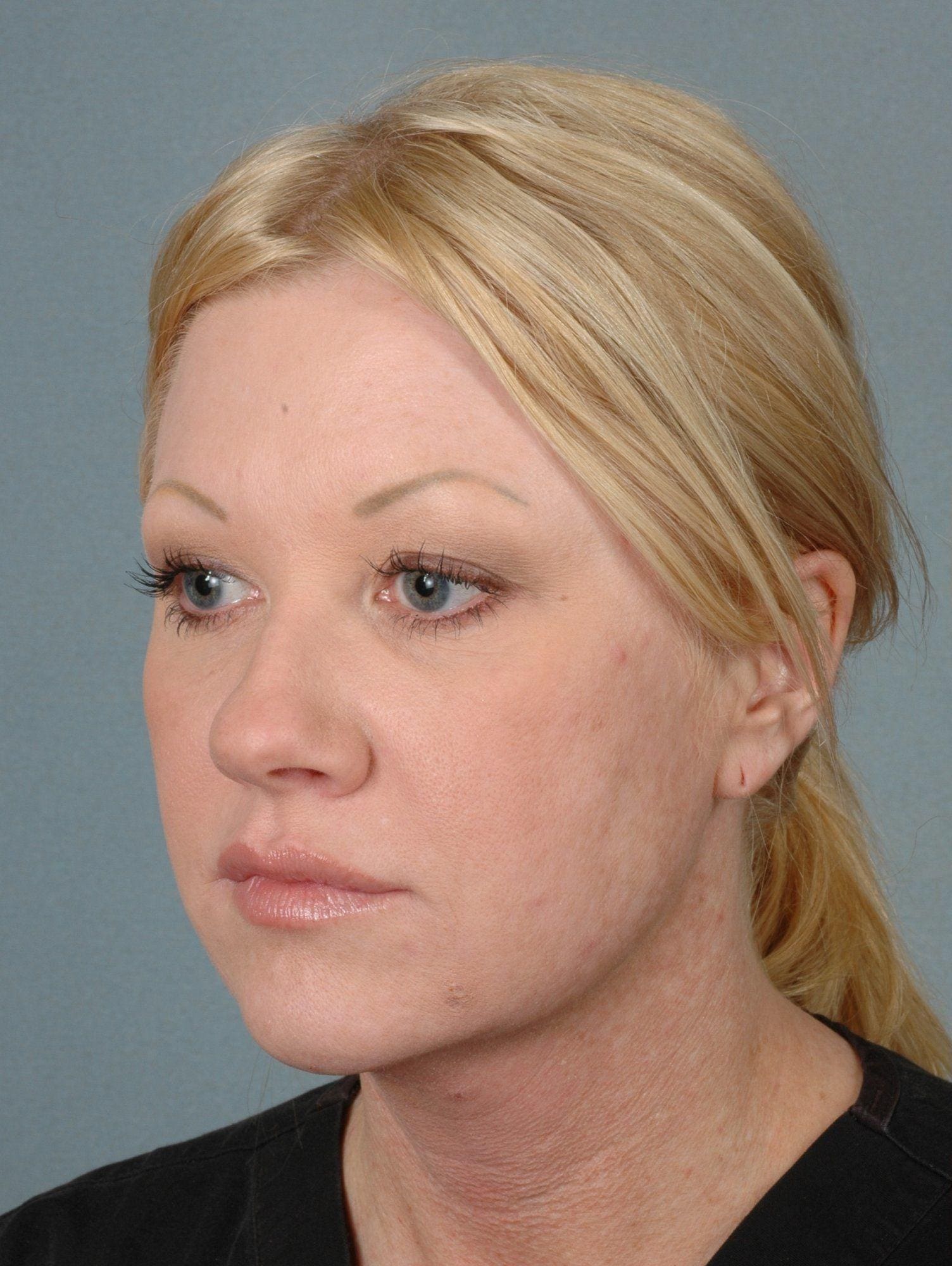 Rhinoplasty Patient Photo - Case 16498 - before view-2