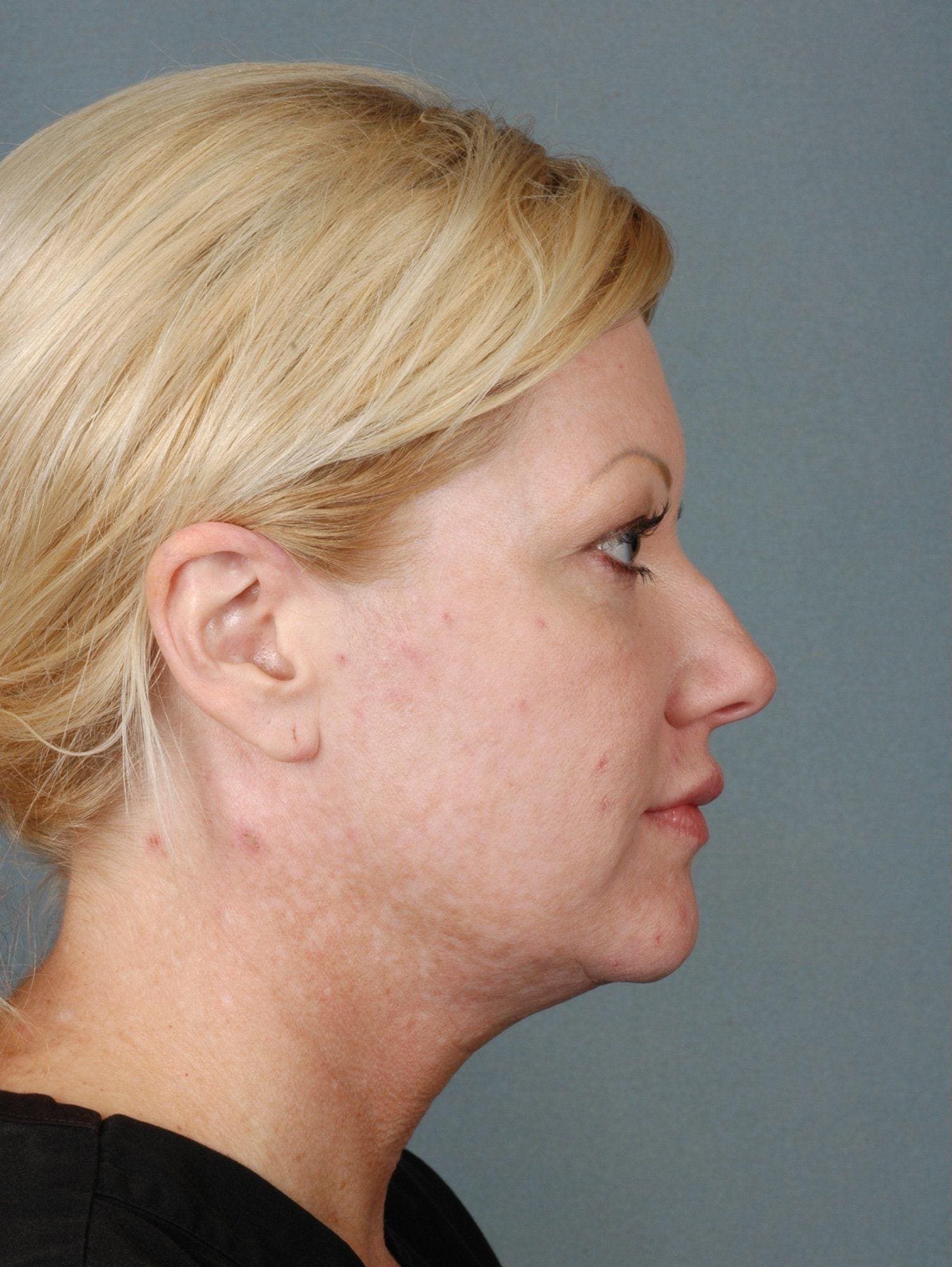 Rhinoplasty Patient Photo - Case 16498 - before view-1