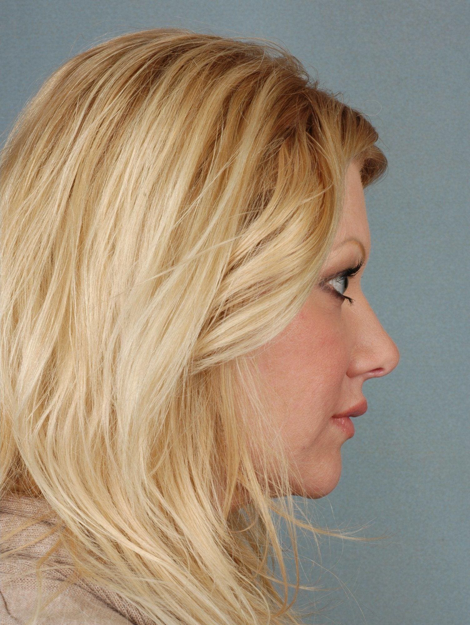 Rhinoplasty Patient Photo - Case 16498 - after view-1