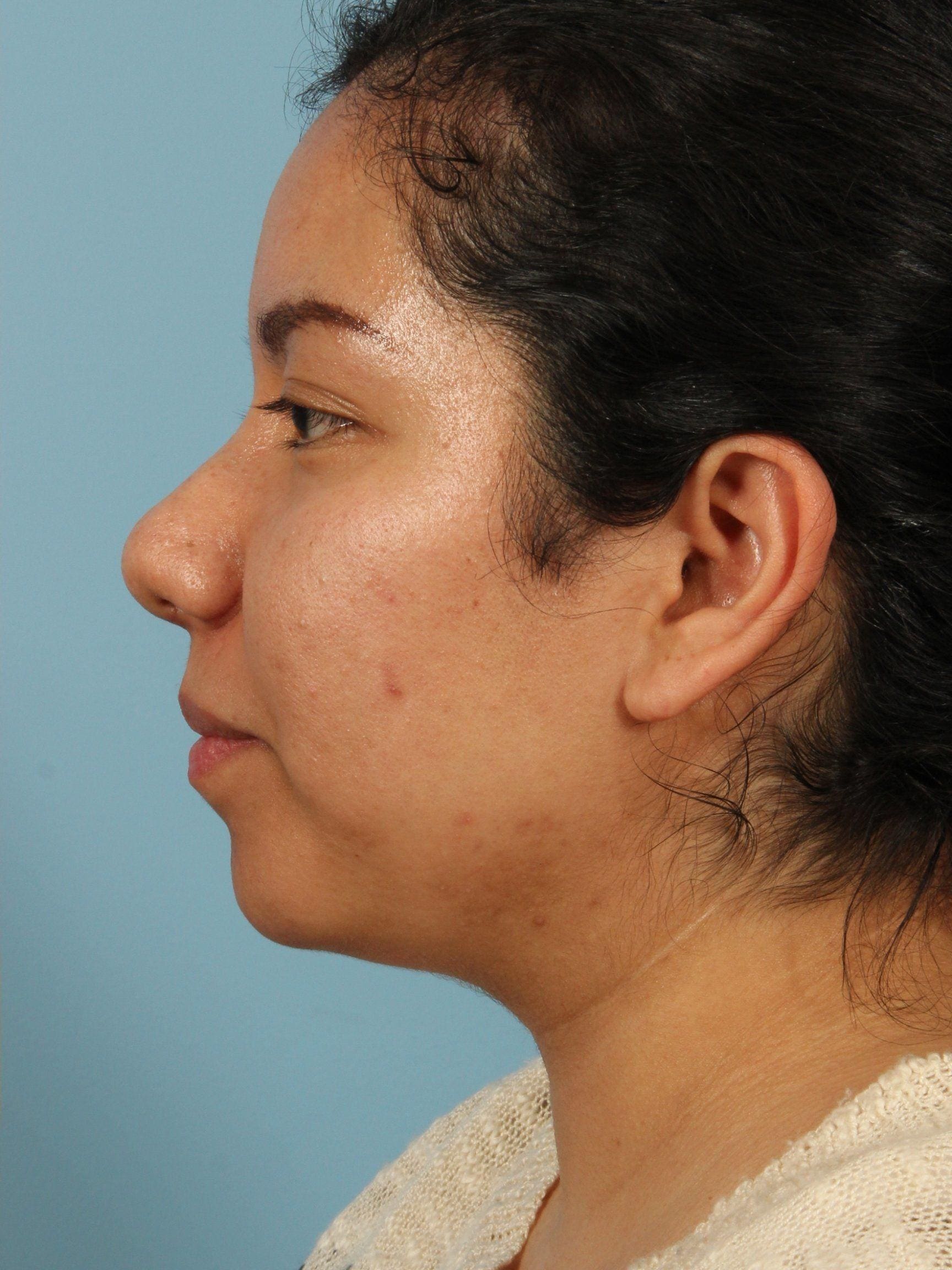 Rhinoplasty Patient Photo - Case 16506 - after view-1