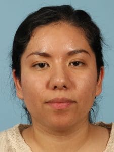 Rhinoplasty - Case 16506 - After