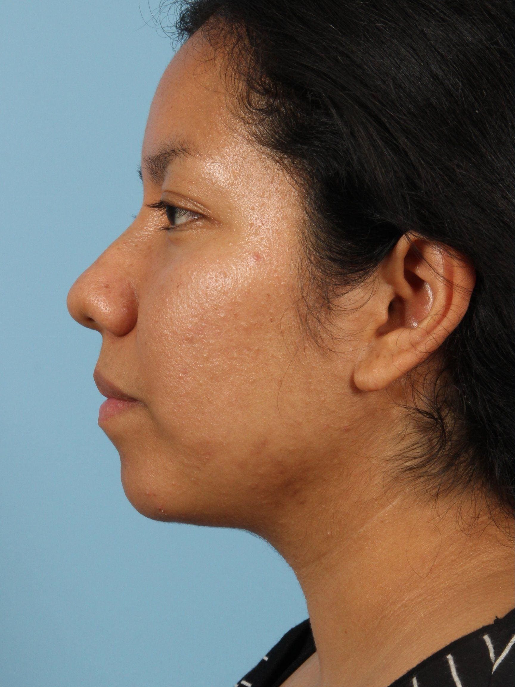 Rhinoplasty Patient Photo - Case 16506 - before view-1