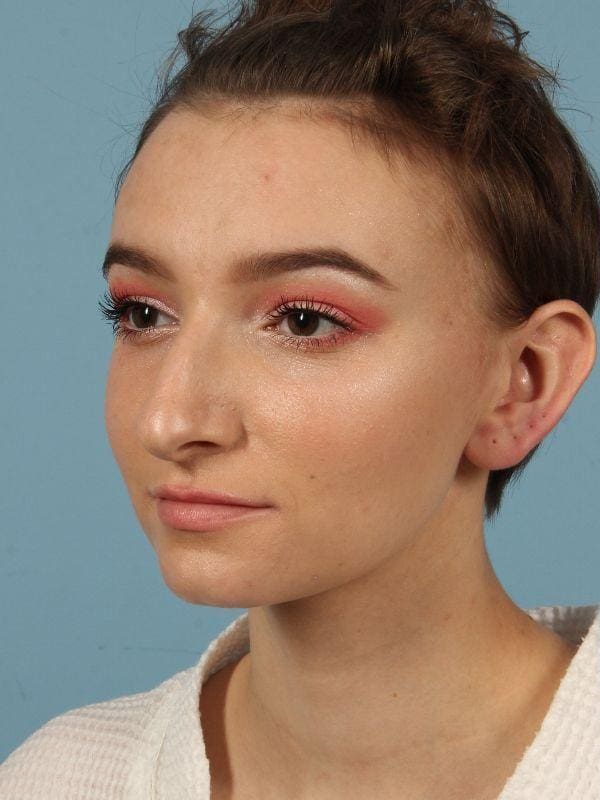 Rhinoplasty Patient Photo - Case 16513 - before view-3
