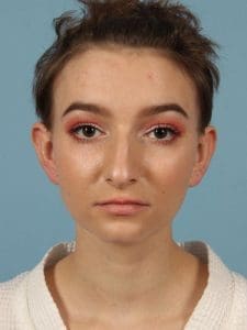 Rhinoplasty - Case 16513 - Before