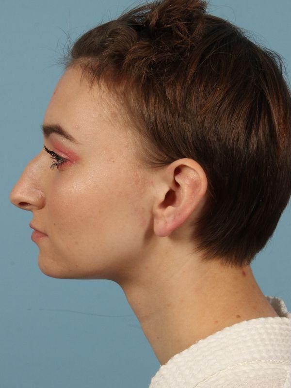 Rhinoplasty Patient Photo - Case 16513 - before view-1